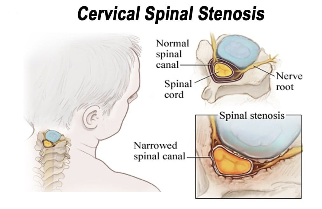 Cervical Spinal Stenosisl